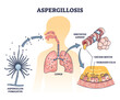 © VectorMine - Aspergillosis lung infection caused by Aspergillus, outline diagram, transparent background.Irritated airway, excess mucus and damaged cilia caused by common mold fungus spores.Microbiological danger.