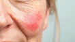 © Sunday Cat Studio - Close-up of a woman's face showing red skin irritation, highlighting dermatological issues or allergic reactions.