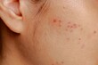 © agencies - Asian woman facial skin with red spots and swelling after acne laser  treatment and popping by dermatologist to removed acne after  1 day.