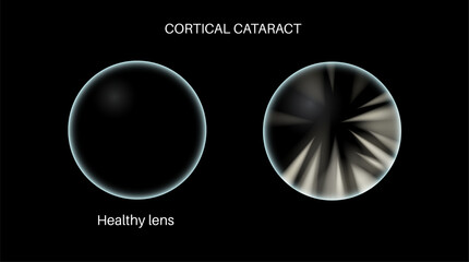 Sticker - Cataract eye disease