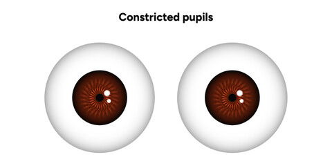 Constricted pupils eye diseases ophthalmology