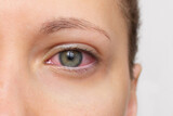 Close up of woman face with red eye. Swollen eyelids, irritation and itching of eyes caused by conjunctivitis, allergy, inflammation, infection. Dry eye syndrome