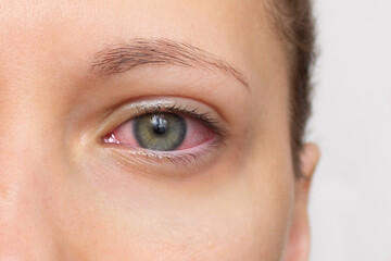 close up of woman face with red eye. swollen eyelids, irritation and itching of eyes caused by conju