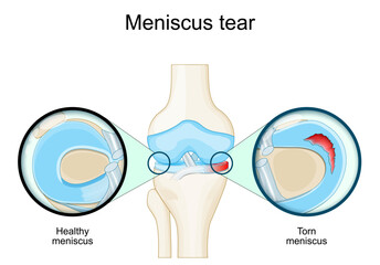 Poster - Meniscal tear. Knee anatomy. Close-up of Torn meniscus