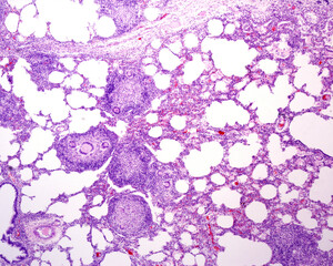 Poster - Human lung. Tuberculosis