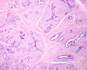 Wall Mural - Human breast intracanalicular fibroadenoma.