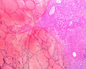 Poster - Human liver haemangioma