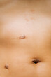 © Mal de Ojo Studio/Stocksy - Laparoscopic Suture Scars