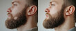 © Cantarela - Collage of two photos of a man with a problem of hair loss on his beard before and after treatment, anti-hair loss procedures, hair transplant, on a light background, collage. Visit to a trichologist.