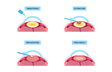 Canvas Print - Cataract surgery poster