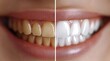 © YONG - A before-and-after photo of teeth, one set with yellowish tones and the other with a bright white color tone.