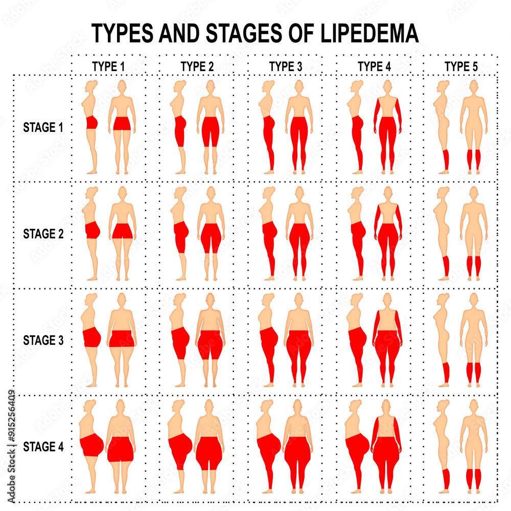 types-and-stages-of-lipedema-stock-illustration-adobe-stock