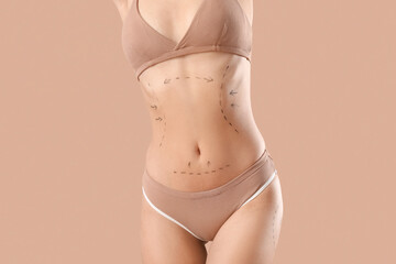 Poster - Young woman in underwear with marks on her body against beige background. Plastic surgery concept