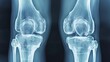 © LuvTK - Anterior X-ray of the knee with clear signs of ligament tears or damage, detailed bone and ligament visualization, sharp and precise imaging, blue-gray scale, clean medical imaging, radiology setting.
