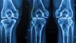 © LuvTK - Composite X-ray image of knee joints from multiple angles, highlighting arthritis and cartilage wear, high clarity, blue-tinted monochrome, clinical setting, labeled bone structures,