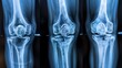 © LuvTK - Composite X-ray image of knee joints from multiple angles, highlighting arthritis and cartilage wear, high clarity, blue-tinted monochrome, clinical setting, labeled bone structures,