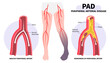 © Pepermpron - Foot pain with Peripheral artery disease and fatty clot in leg veins or injury that cause high blood pressure