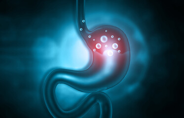 Wall Mural - Human stomach with gas problems. 3d illustration.