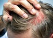 © Wanlop - Close-up of a person's hand scratching their scalp, revealing flaky skin and redness, illustrating the discomfort and irritation of an itchy scalp condition.