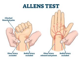 Sticker - Allens test illustration, transparent background.Labeled physical arterial blood examination scheme.Educational explanation with medical test method steps.