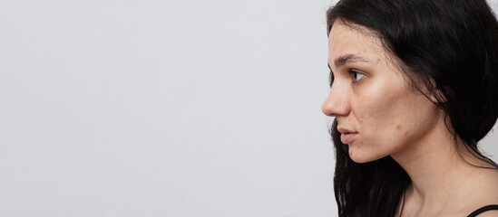 A large portrait of a young woman with skin problems - pimples, acne, enlarged pores. A place for your text.