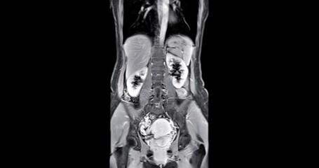 Wall Mural - MRI abdomen coronal views are particularly useful for assessing liver, kidneys, and other abdominal organs with precision.