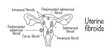 © Anna - Uterine fibroids