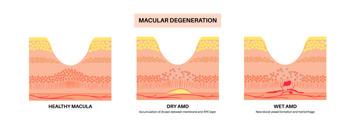 Canvas Print - Macular degeneration poster