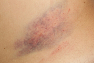 Wall Mural - close up view of a nasty bruise