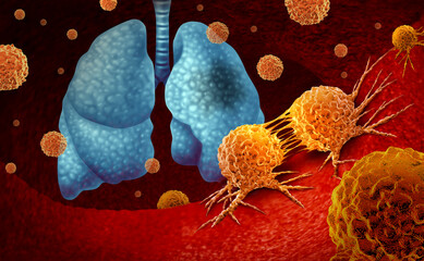 Wall Mural - lung cancer or pulmonary carcinoma diagnosis and human lungs disease symptoms concept as a decline i