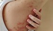 © Rung Kh - close up of a patient scratching the rash hives allergy and inflammation skin, reaction and urticaria, scar and dark spots, inflammation skin on the body, health care and medical concept.
