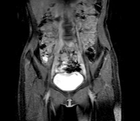 Wall Mural - MRI abdomen coronal views are particularly useful for assessing liver, kidneys, and other abdominal organs with precision.