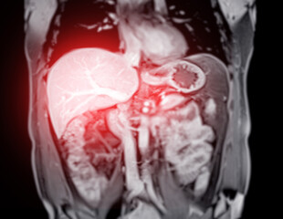 Wall Mural - MRI abdomen coronal views are particularly useful for assessing liver, kidneys, and other abdominal organs with precision.