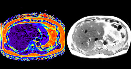 Wall Mural - An MRI PET scan of the abdomen in axial view provides a detailed cross-sectional image, helping to detect abnormalities with high precision.