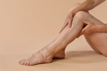 Canvas Print - Woman suffering from varicose veins on beige background, closeup. Space for text