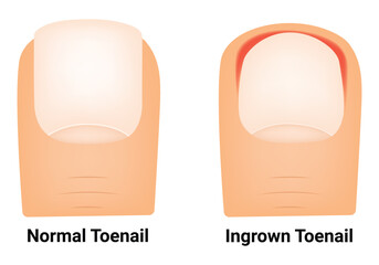 Normal Toenail and Ingrown Toenail Science Design Vector Illustration Diagram