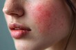 © DK_2020 - Person with rosacea, skin improved texture and appearance