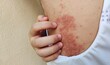 © Rung Kh - portrait the atopic dermatitis, itchy and allergy, chronic dermatitis and eczema on the body, rash, hives, and peeling on back of a patient woman, inflammation skin, health care and medical concept.