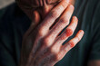 © Daniel - Closeup men itching and scratching by hand. Psoriasis or eczema on the hand. Atopic allergy skin with red spots