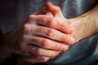 © Daniel - Closeup men itching and scratching by hand. Psoriasis or eczema on the hand. Atopic allergy skin with red spots