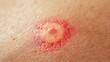 © Chudapa - Macro shot of a red, ring-shaped rash on human skin, potentially indicating a tick bite, infection, or allergic reaction, highlighting dermatological and health concerns
