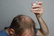 © millaf - Mature man applying hair loss serum or minoxidil on bald scalp