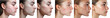 © pawimon - Skin transformation showing acne progression and improvement