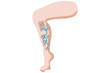 © RAVINDU - A venous leg ulcer is a chronic, slow-healing sore on the lower leg caused by poor blood circulation due to venous insufficiency. Related diseases: varicose veins,deep vein thrombosis, lymphedema