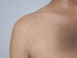 © alphaonetwo - stretch marks on armpit skin area