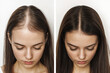 © Mariya - Before and after hair restoration in female patient. Illustration of transformation in hair density and scalp health post transplantation. Woman with hair loss problem. Hairloss treatment, collage.