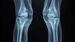 © Iswanto - X-ray image of two healthy human knees, showing the bone structure of the knee joint.