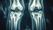 © Iswanto - A close-up X-ray image of two human knees, showcasing the bone structure and joints.