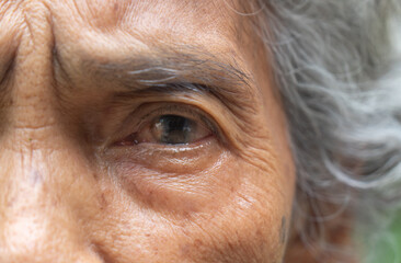 Elderly Asian woman looking up and Cataract eyes awaiting treatment