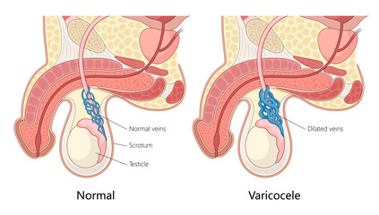 Wall Mural - normal veins and varicocele, dilated veins in the scrotum affecting the testicle hand drawn schematic vector illustration. Medical science educational illustration